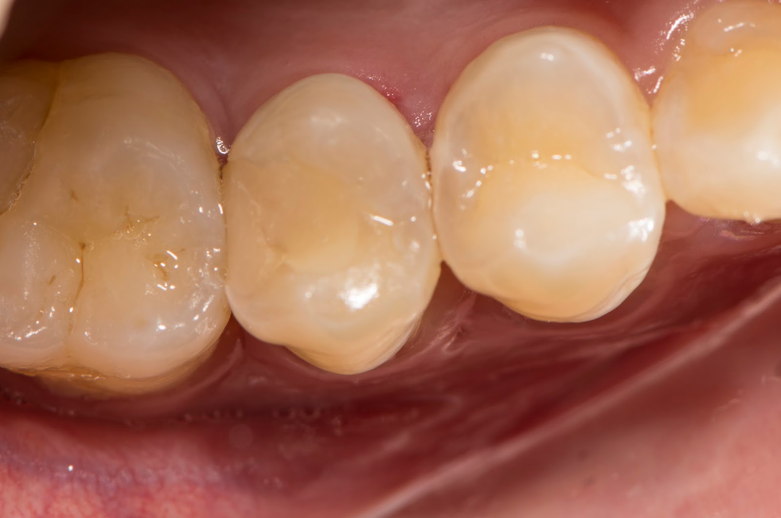 Composite Restoration