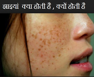 Pigmentation on Face in Hindi, पिगमेंटेशन क्या और क्यों होती है , चेहरे पर झाई 