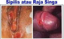 Penyakit Raja Singa Bisa Sembuh Penyakit Raja Singa Bisa Sembuh