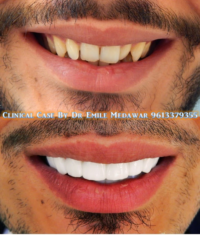 Hollywood Smile Options
