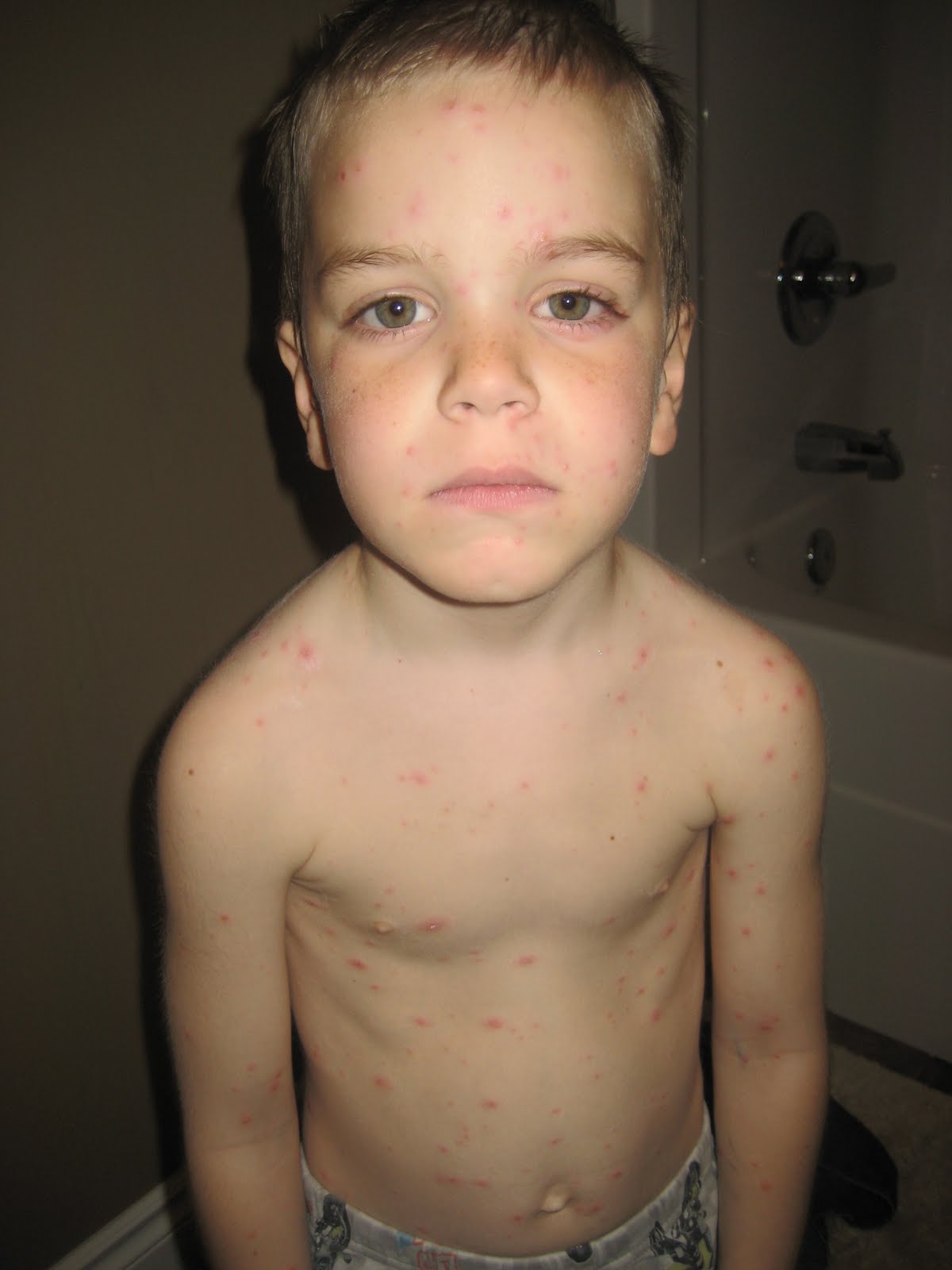 Evans Journal: Chicken Pox