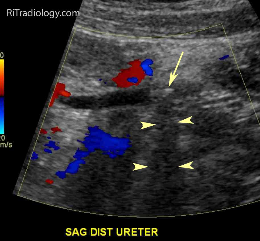 ureterolithiasis for ct stonogram