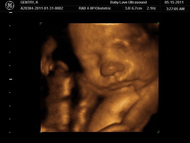 3d vs 4d ultrasounds 3d vs 4d ultrasounds
