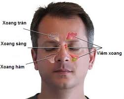 BỆNH VIÊM XOANG SÀNG SAU
