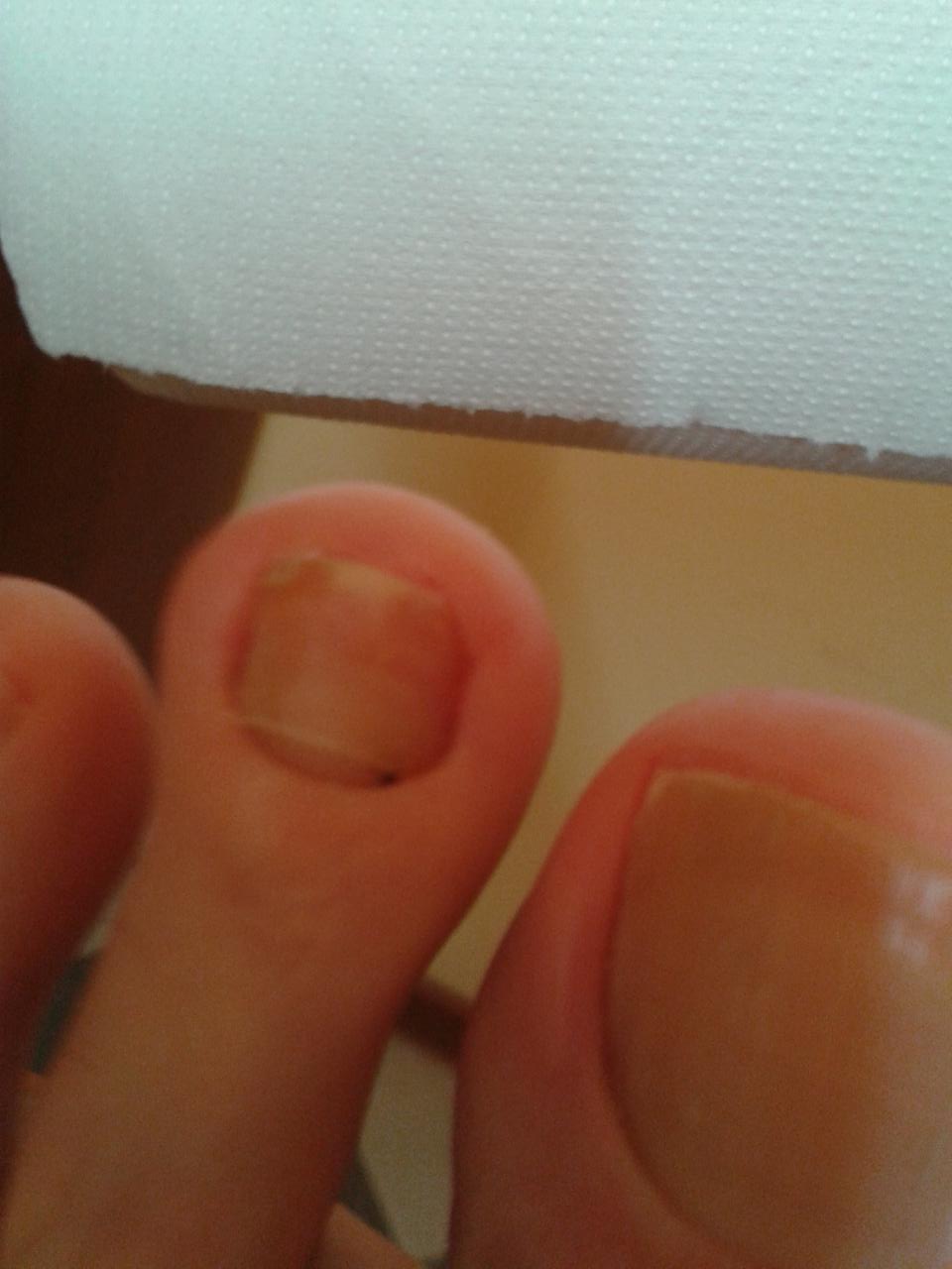 Zdrowe Nogi Czarny Paznokiec