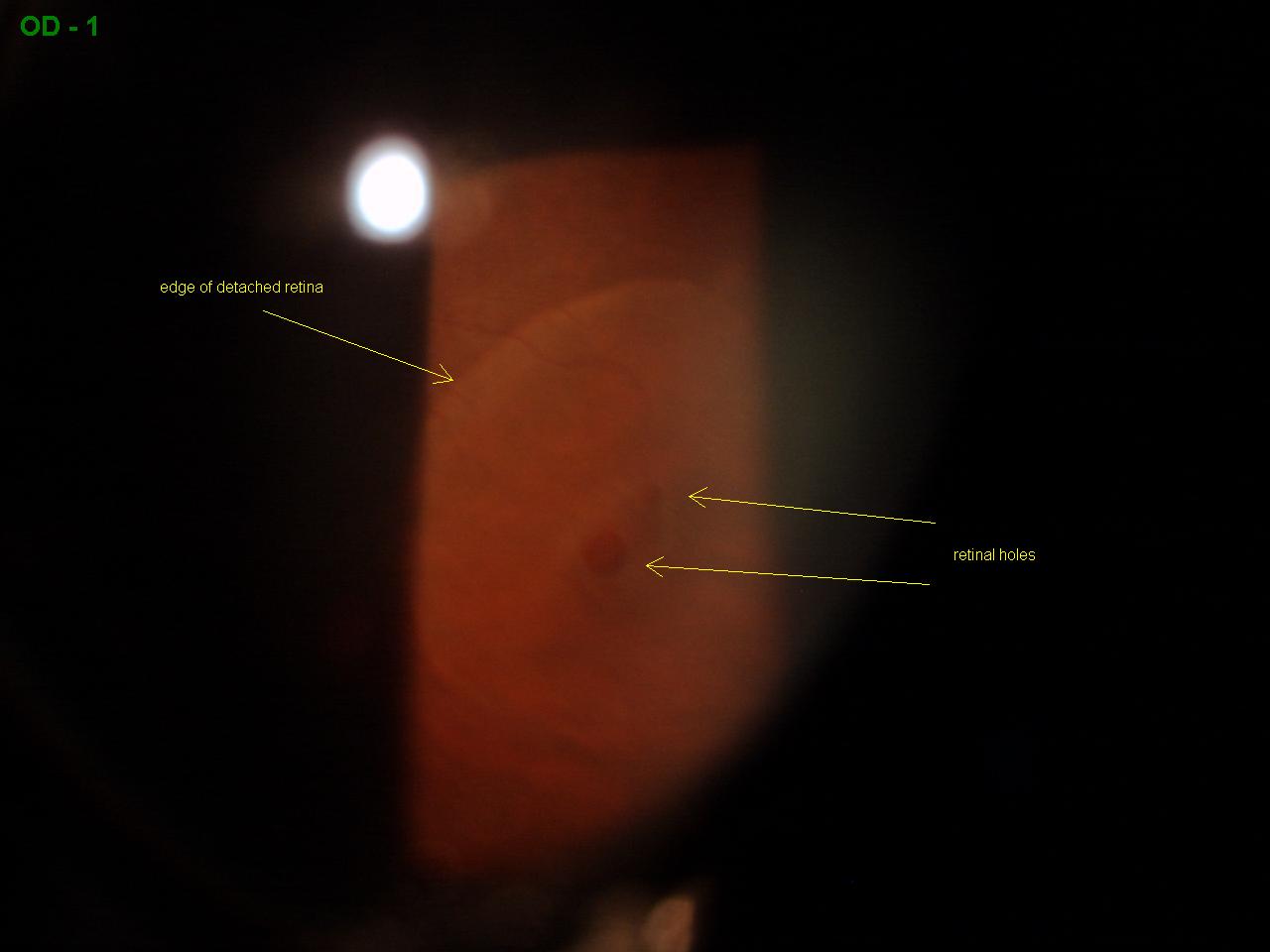hole in eye retina hole in eye retina