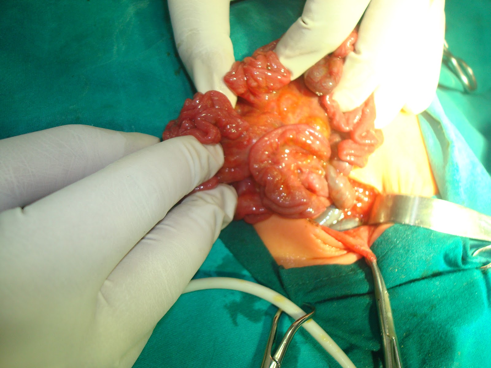 Mesenteric Swirl Sign