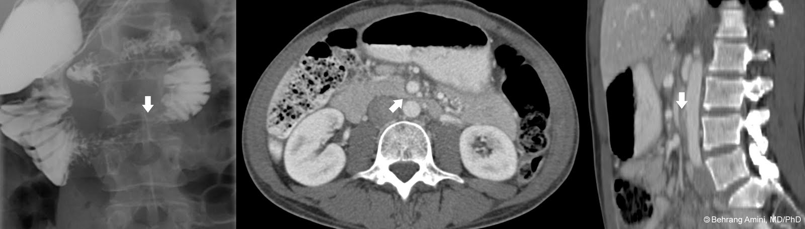 sma syndrome