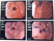 Stomach Cancer Pictures