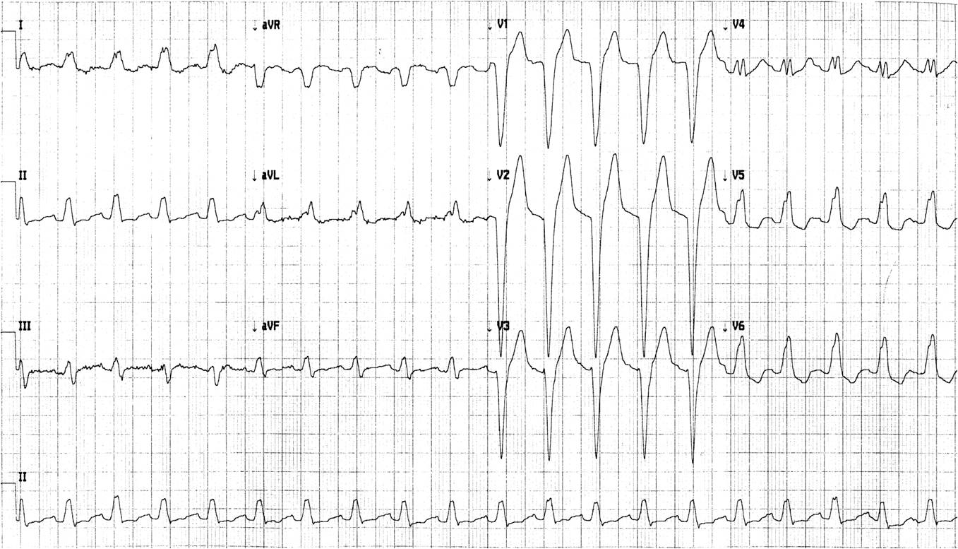 ecg lbbb