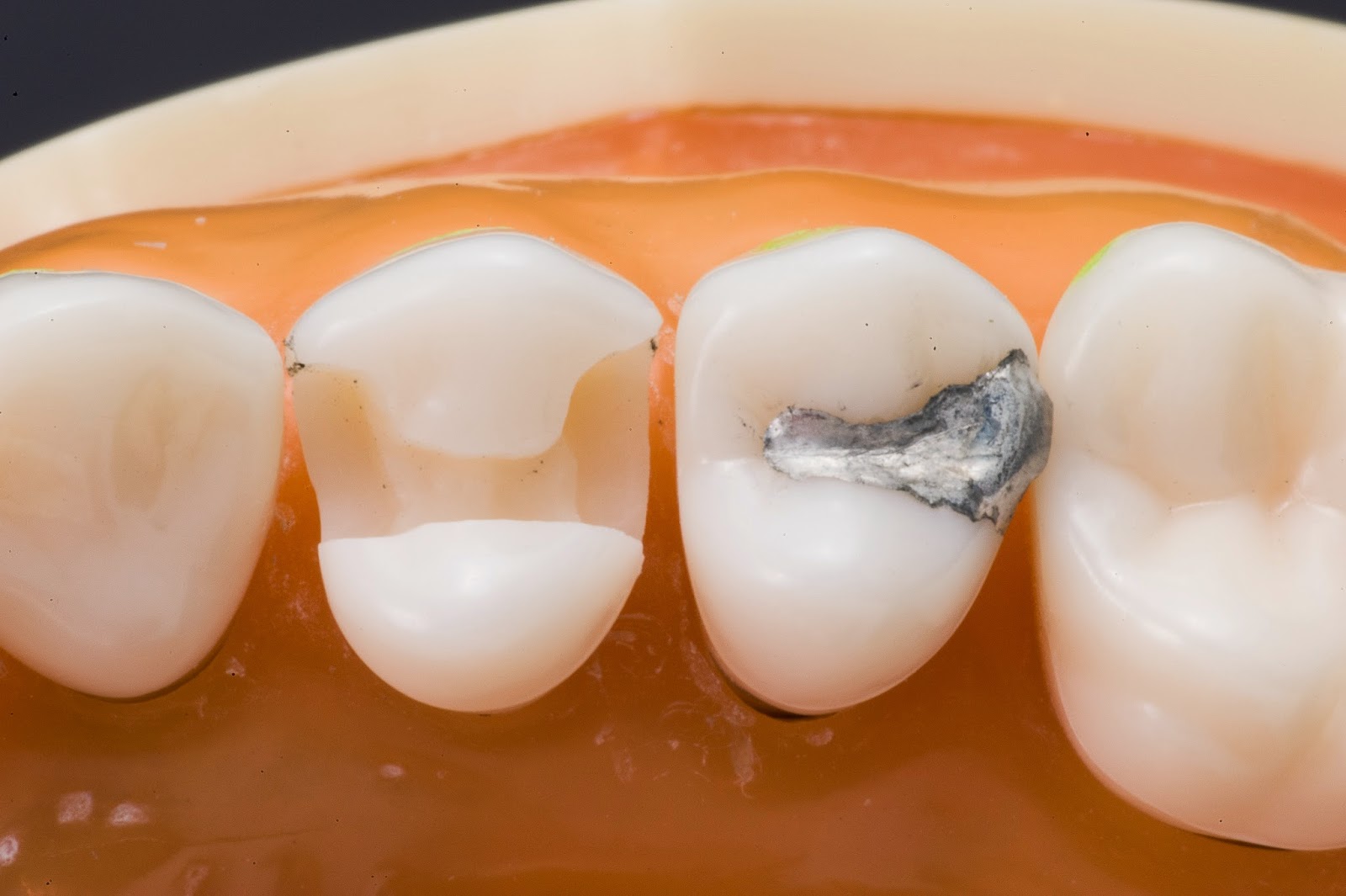 MOD Composite Preparation and Restoration 1 12 MOD preparation 13 DO