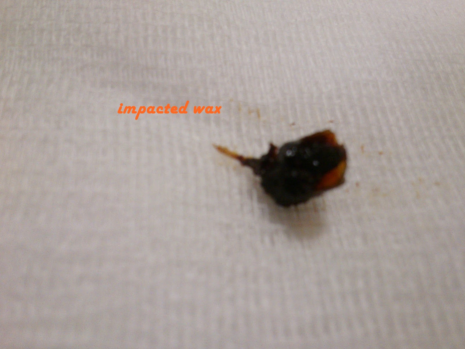 under the sky what to do muffled hearing, impacted wax