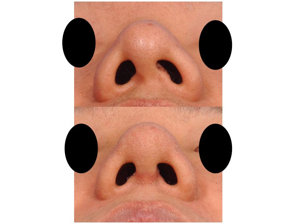 Shimmian Rhinoplasty Clinic (official blog in Korea) Correction of the