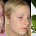 How To Get Rid Of Acne With Aloe Vera - Remedy