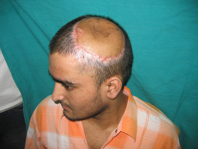 Tattoo Abscess