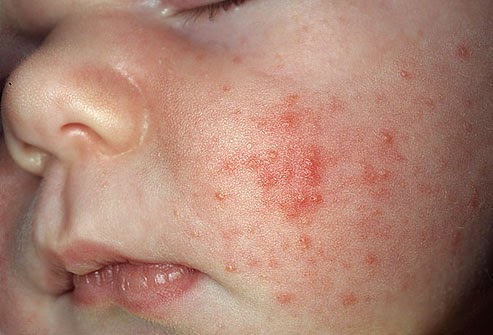 How to Get Rid of Baby Acne How to Get Rid of Baby Acne