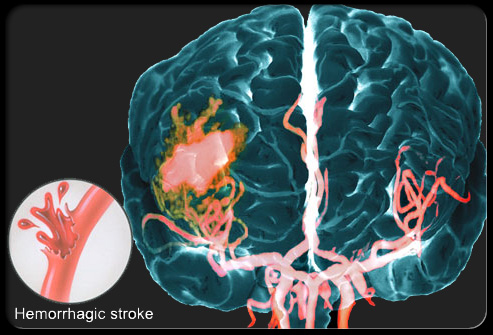 Hemorrhagic Stroke Risk Factors