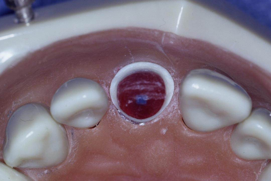 Dentistry Custom Cast Dowel Core