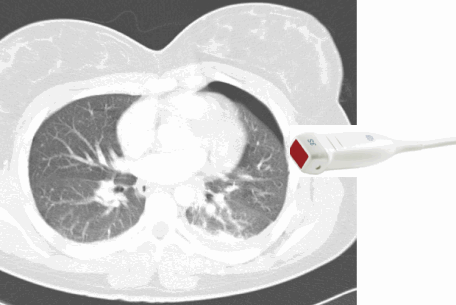 HydroPoint Ultrasound sign of airfluid level in the pleura