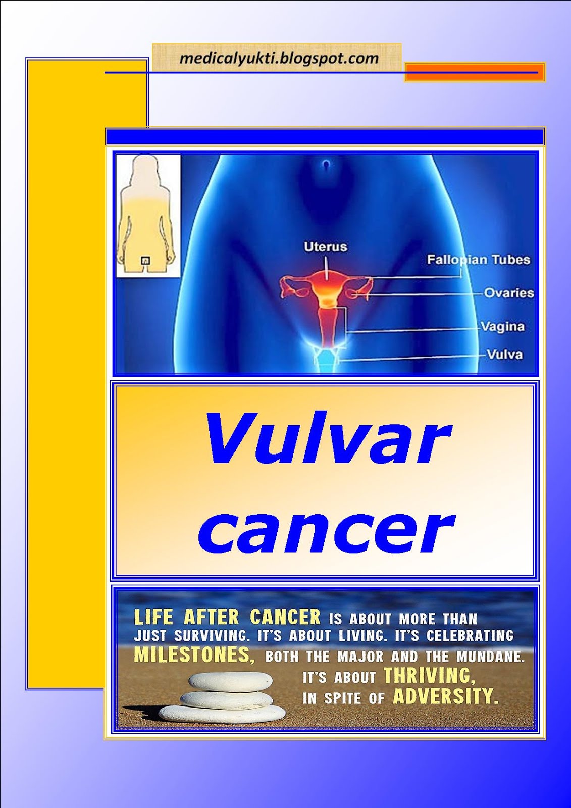 Vulvar-Cancer