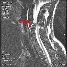 humanlifematters wanting to be disabled severed spinal cord