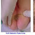 Harga Obat Kutil Kelamin Ampuh thumbnail