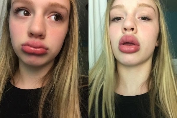 Kylie Jenner Challenge Pictures Swollen Lips: Effects of Kylie Jenner Challenge
