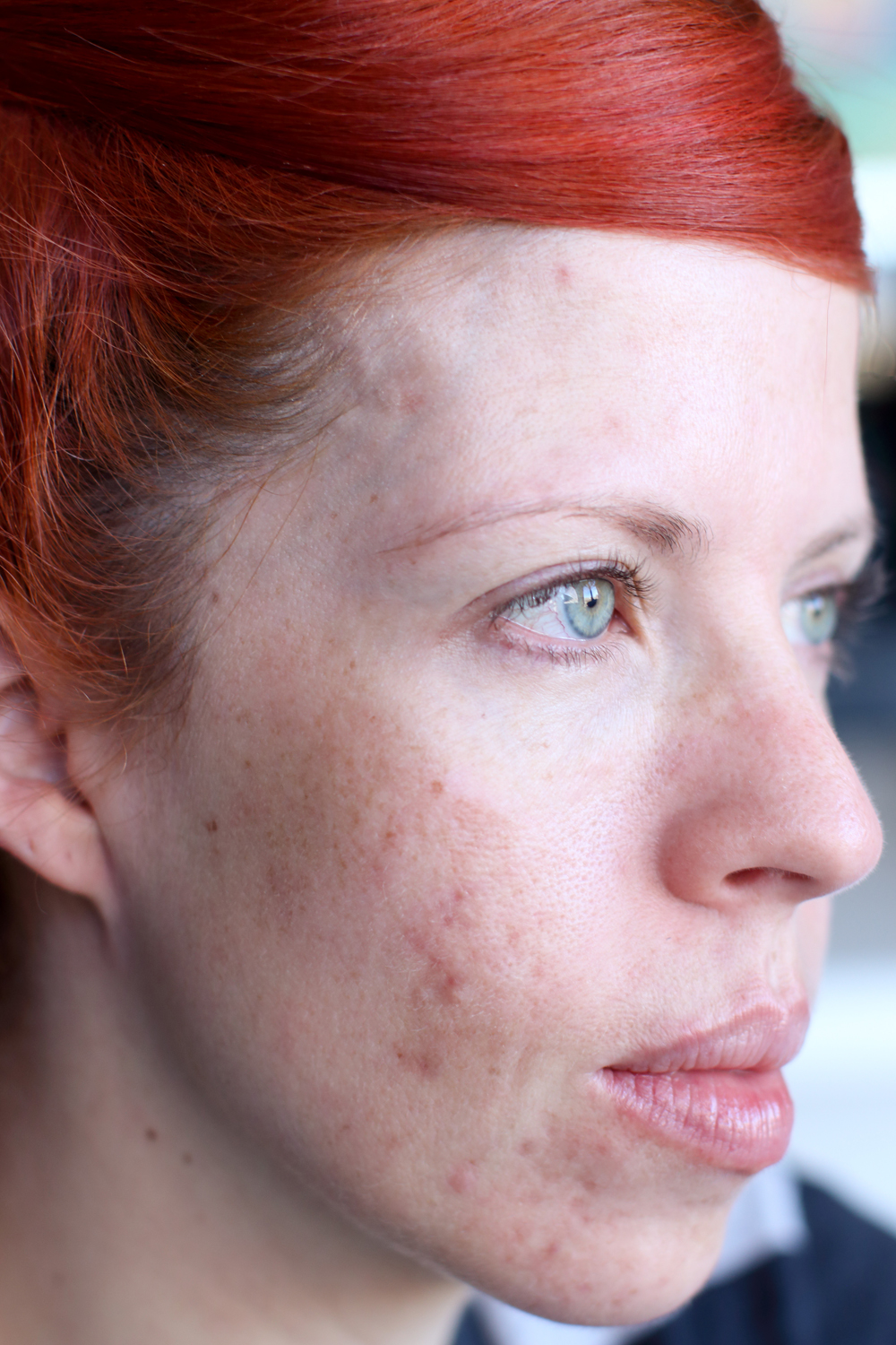 does accutane make your nose smaller does accutane make your nose smaller