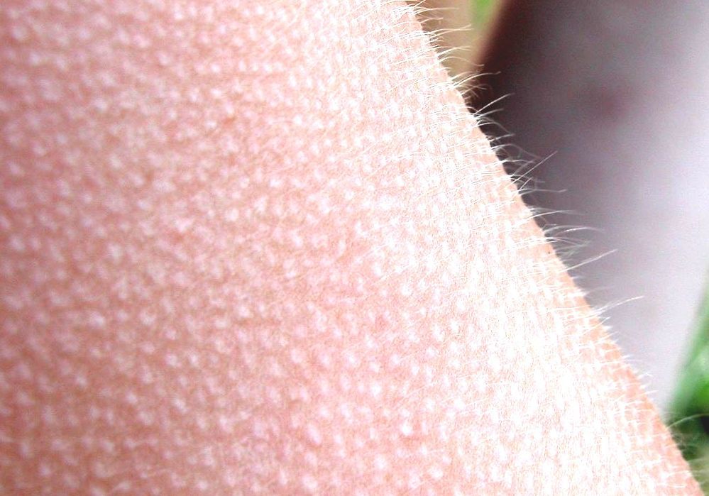 Goose Bumps Bump Human Hair
