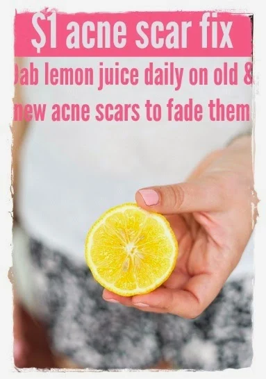 Beauty Hack #14: Add a spot of lemon juice to reduce acne scars