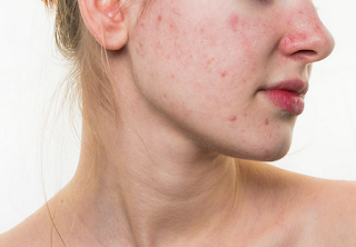 How to get rid of acne by understanding the true cause of the problem How to get rid of acne by understanding the true cause of the problem