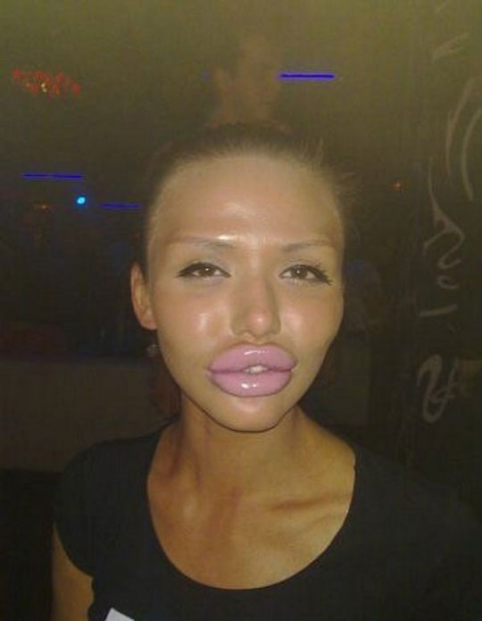 Botox Lips