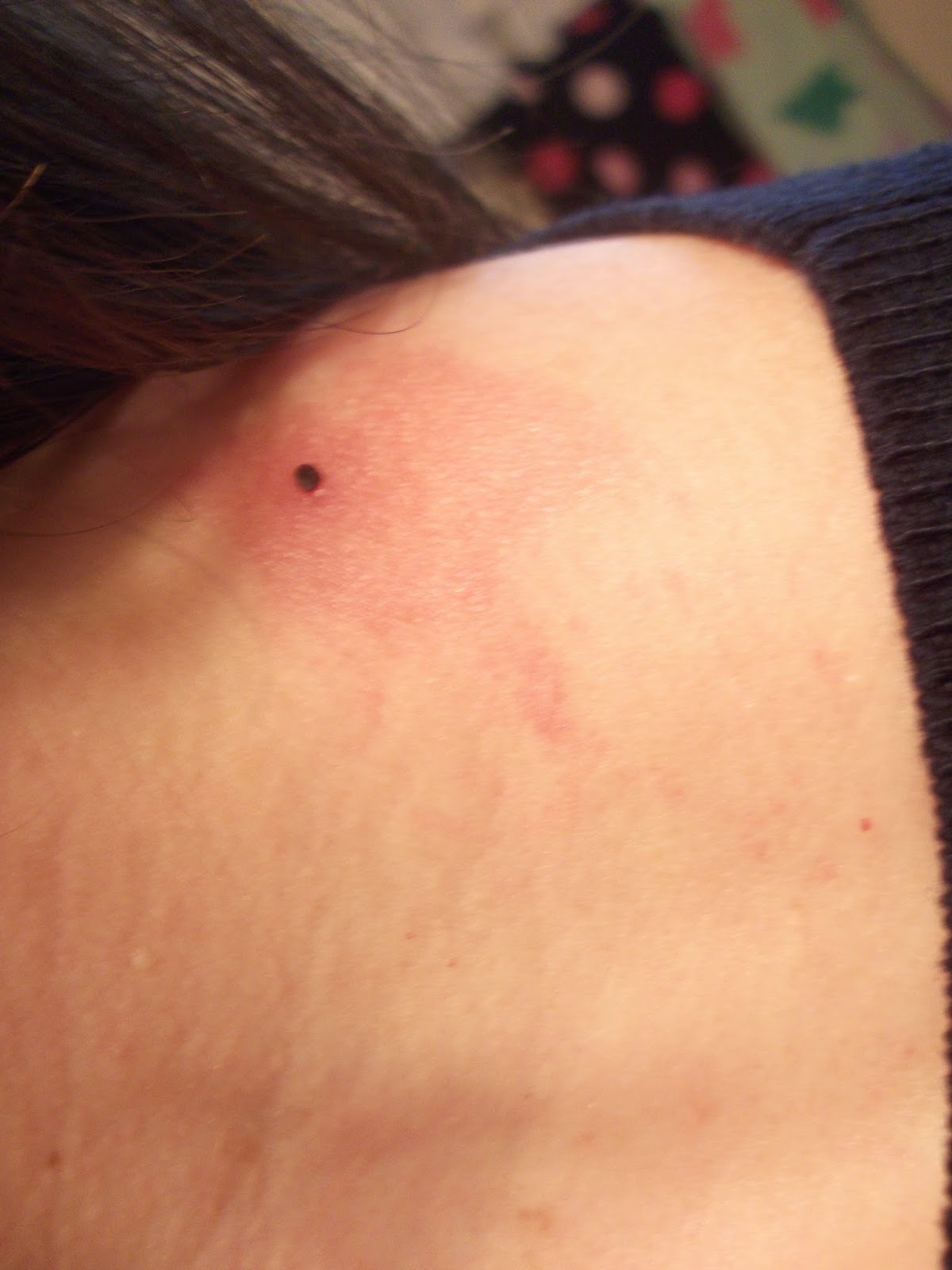 Exploring Real Food How My Skin Tag Disappeared Using Tea Tree Oil