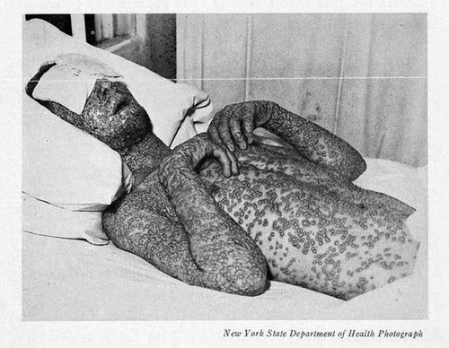an analysis of smallpox During the global program of smallpox eradication, the world health organization variola minor: a personal analysis of 13,686 cases bull hyg 194823: 735-746. an analysis of smallpox During the global program of smallpox eradication, the world health organization variola minor: a personal analysis of 13,686 cases bull hyg 194823: 735-746.