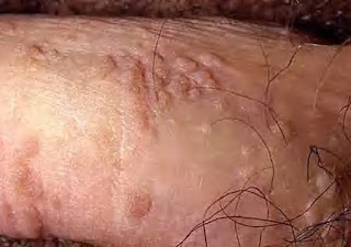 Mengobati kutil di sekitar kemaluan dengan obat herbal alami jual obat herbal untuk kutil kelamin