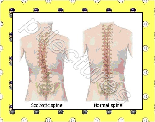 Define Muscular Dystrophy