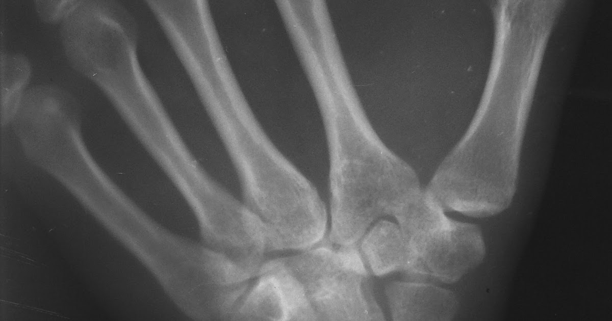 Fracture Wrist Fracture Treatment