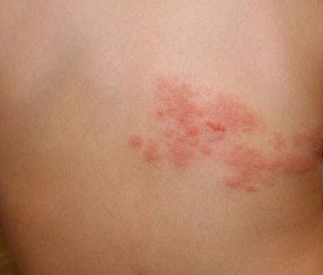 valacyclovir used for shingles