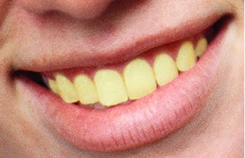 why are people born with yellow teeth