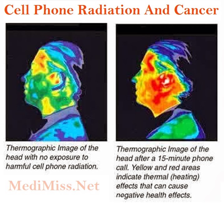 an examination of the effects of gamma rays on skin cancer Radiation - radionuclides in diagnosis to 10 ergs energy of gamma radiation transferred to one gram of effects on the incidence of cancer. an examination of the effects of gamma rays on skin cancer Radiation - radionuclides in diagnosis to 10 ergs energy of gamma radiation transferred to one gram of effects on the incidence of cancer.