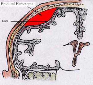 epidural hemorrhage