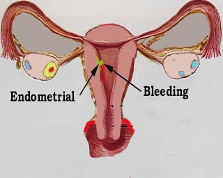 cara mengobati hiperplasia endometrium tanpa kuret