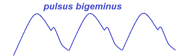 MBBS Medicine (Humanity First) Abnormal Pulses and Possible Etiologies