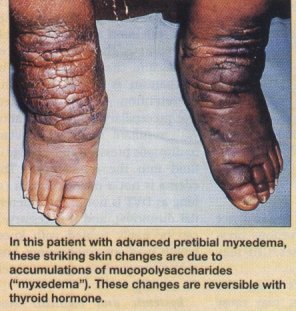 Health & Fitness: Natural Cures for Low Thyroid