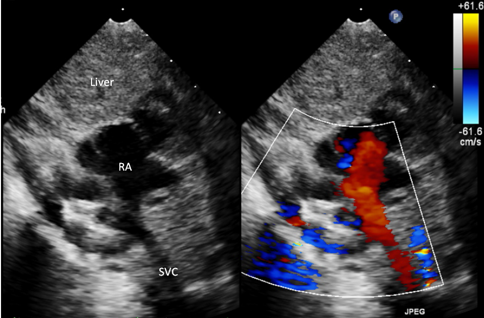 Pedi cardiology: Anatomy: Interrupted IVC with Azygos Vein Continuation