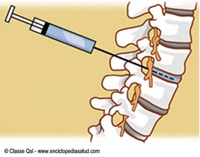 Inyeccion de esteroides en la columna