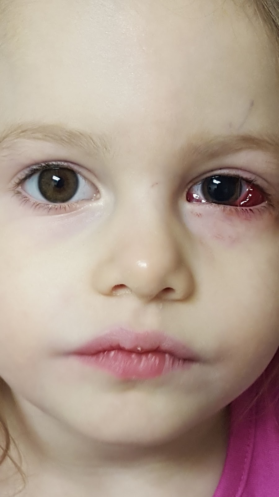 The Patty Cake Patch Strabismus Surgery