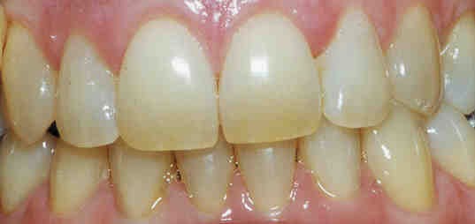 Inconvénients de blanchiment des dents