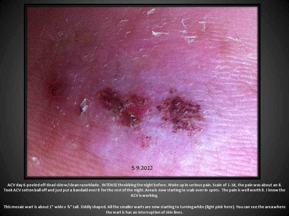 Plantar Wart The Epic Battle Wart?! Plantar Wart The Epic Battle Wart?!