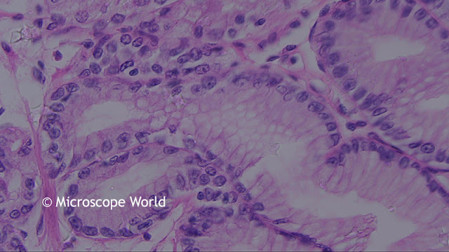 Colon polyp under the microscope at 400x. Colon polyp under the microscope at 400x.